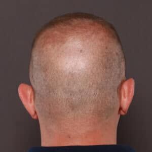FUE scarring FUE scarring Roy & Draper UT