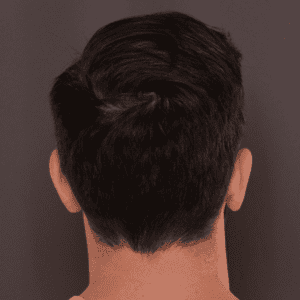 FUT linear scar FUT linear scar Roy & Draper UT