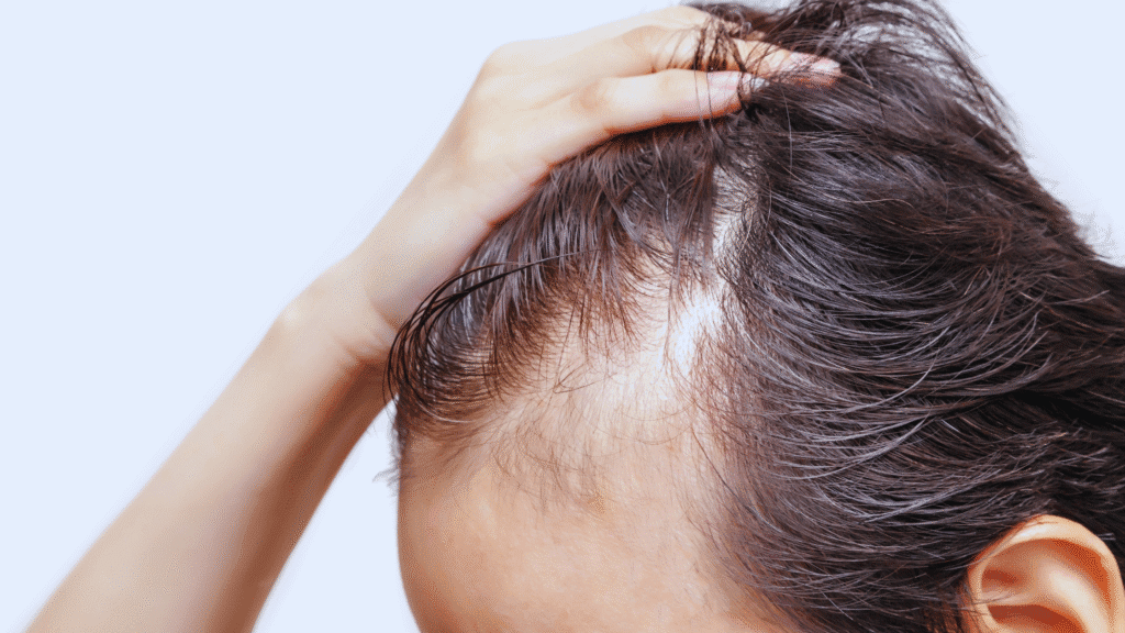 can-you-get-a-hair-transplant-with-alopecia can-you-get-a-hair-transplant-with-alopecia